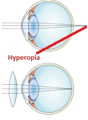 Hyperopia or Farsightedness